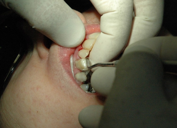 Temporary Composite crown