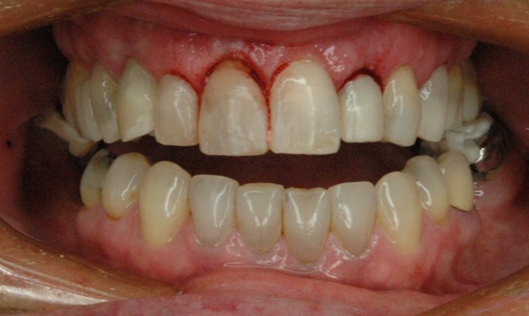 Crown Lengthening - 2010-03-15