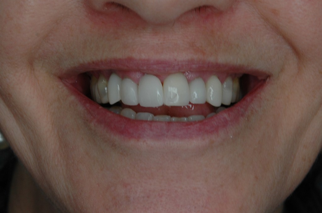 Full Mouth Rehabilitation – Multi Disciplinary Approach – Implant and&nbsp;CadCam