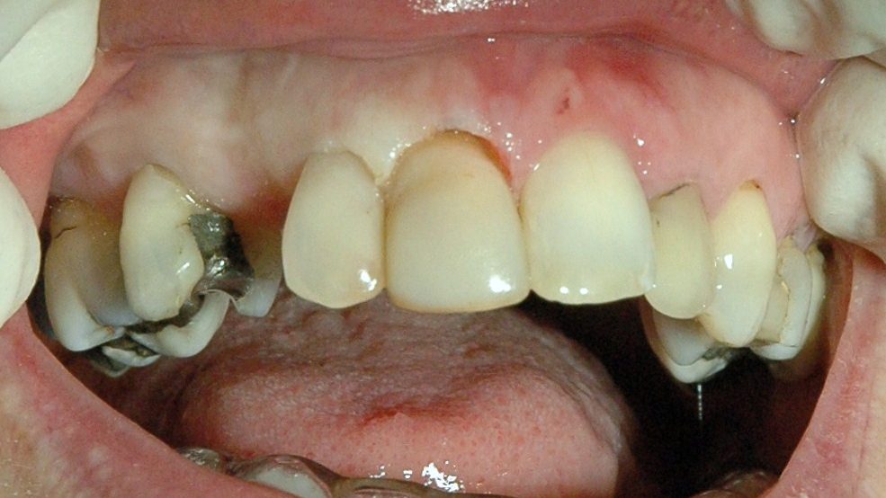 Gingival Symmetry