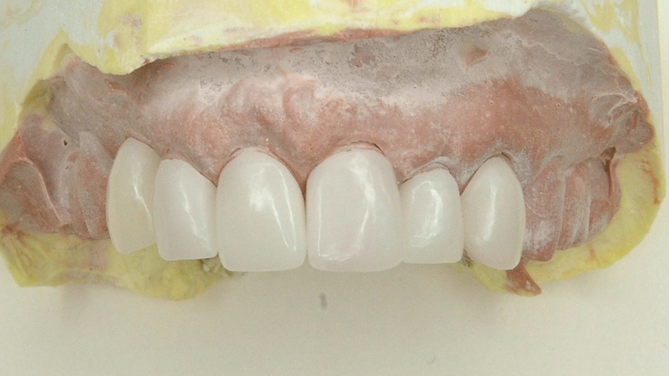 6.0 CAD Restorations - 2010-04-09