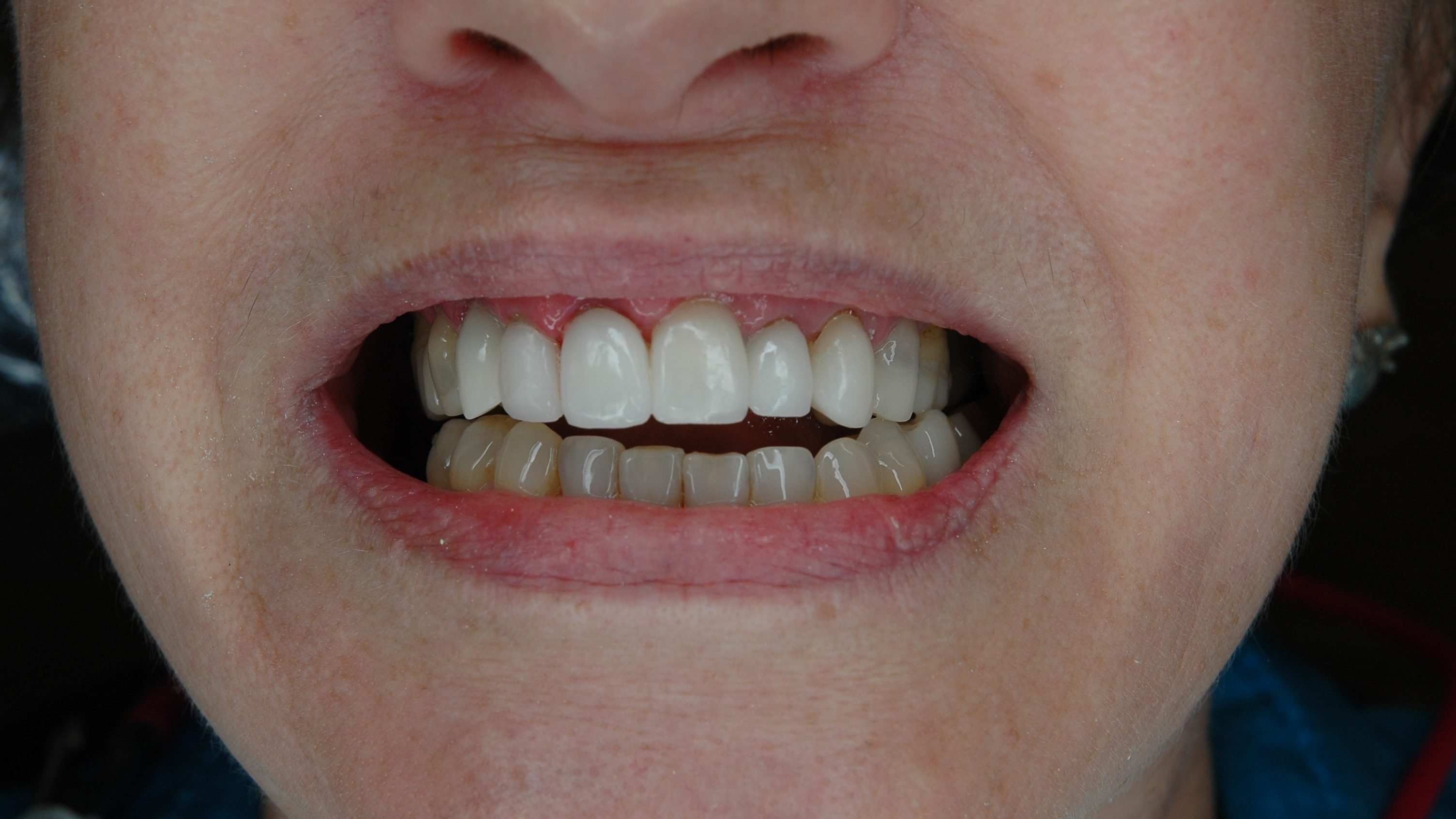 6.2 CAD Restorations