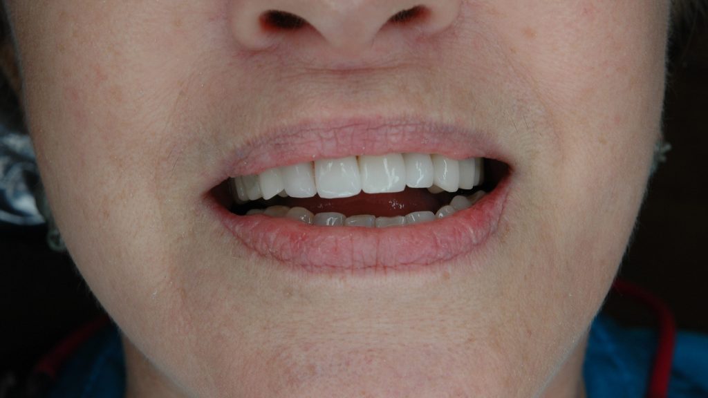 6.3 CAD Restorations