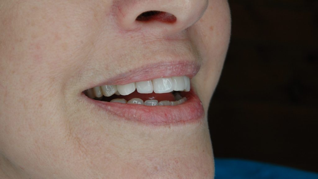 6.5 CAD Restorations