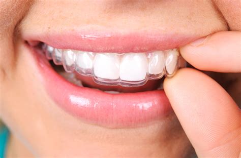 Are you a candidate for aligner orthodontics&nbsp;?
