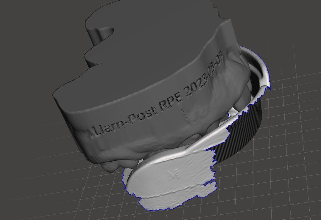 Case Study – Liam.E – Rapid Maxillary Expansion,&nbsp;Myobrace