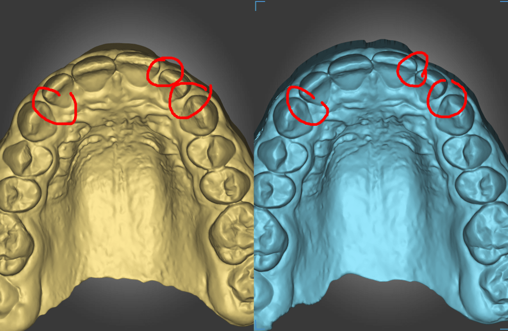 Lily, V-H, 12yo – Myofunctional Therapy (MFT) – Class II div&nbsp;2