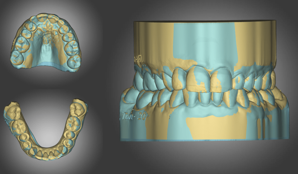 Tara,V – Myofunctional Therapy  (MFT) – Age&nbsp;55