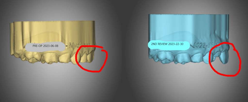 Isaac E. – Myofunctional Therapy – 2nd Progress Report – 2023-11-30