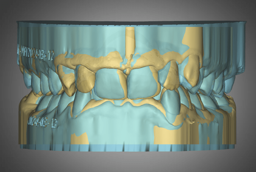 Lara, P – Myofunctional Therapy – Asymmetric Class II Div 2 with > 100% deep bite and retroclined upper&nbsp;centrals