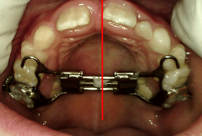 Ella C. – RME + Myobrace – Mixed Dentition, Class II Div 1 with Moderate to Severe&nbsp;Crowding