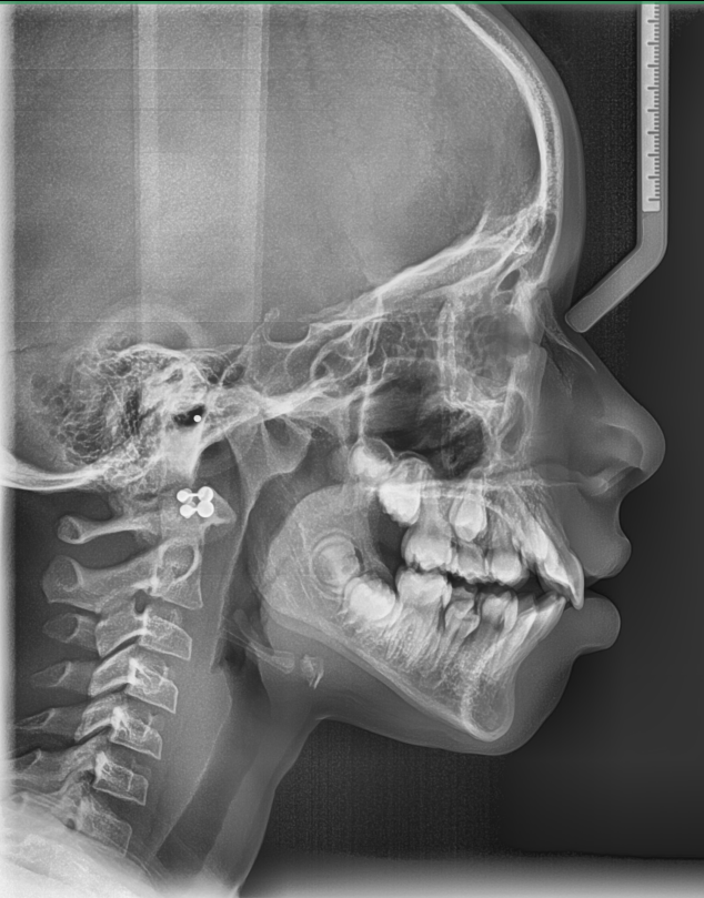Ameyle K. 11 years old- Class II div 2 – Mixed Dentition with moderate crowding