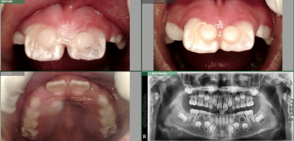 Lucas L – 8yo – Close Diastema before MFT – Class II div 1 and 2 Mixed Dentition