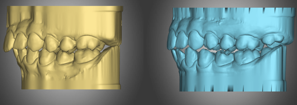 Protected: Sophie, P – MFT, mixed dentition, Class II Div&nbsp;1