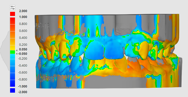 Orlando H. – MFT: Myobrace&nbsp;Treatment