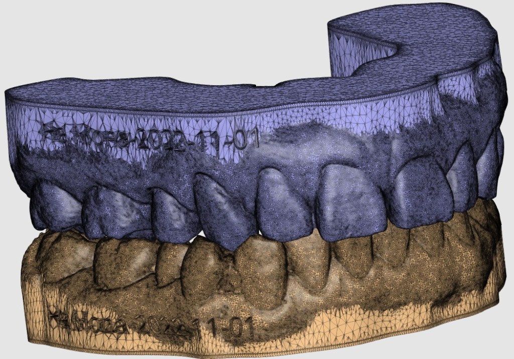 Mona H. – Missing tooth Collapse with Cross Bite Correction – Age 44 Adult&nbsp;Orthodontics