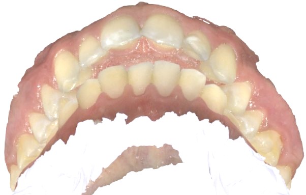Lilu, C. – Anterior Open Bite, Tongue&nbsp;Thrust