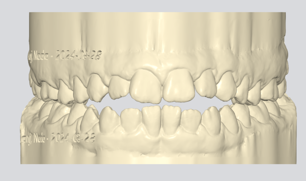 Nada K. – Tongue Thrust – Anterior Open&nbsp;Bite.