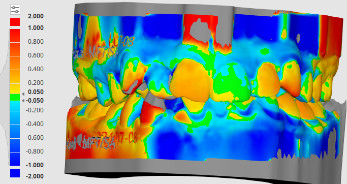 Matias R. – Male Age 10 – Deep Bite – Moderate anterior&nbsp;crowding