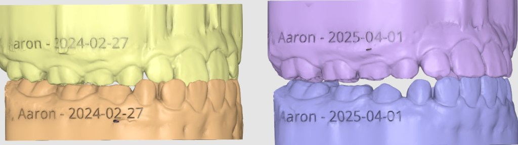 Aaron McK. – Myofunctional Therapy, Mixed&nbsp;Dentition