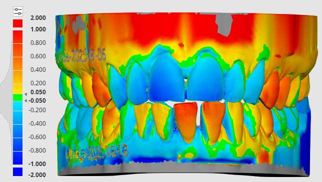 Linda W. – Delayed Onset Tongue Thrust, Adult&nbsp;Myobrace